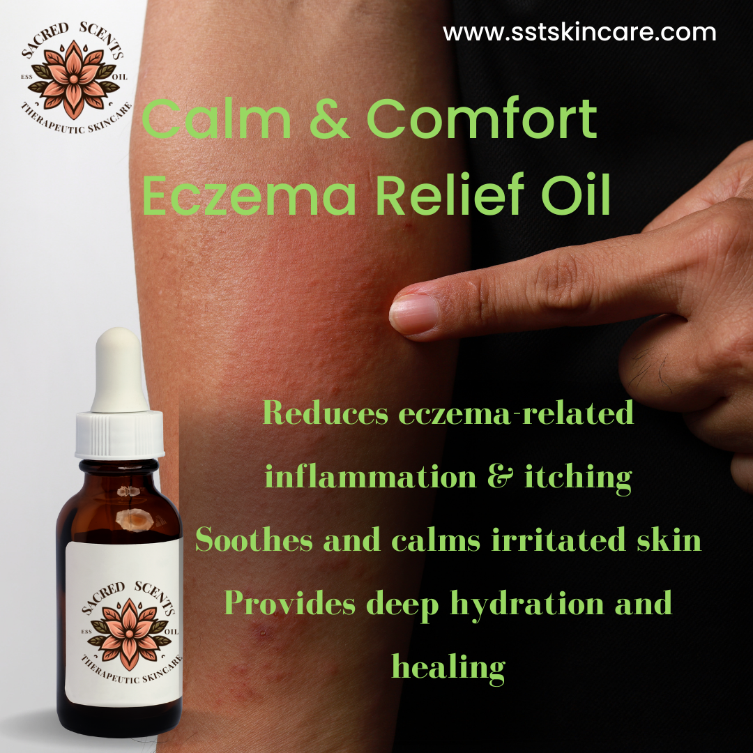 Eczema Relief